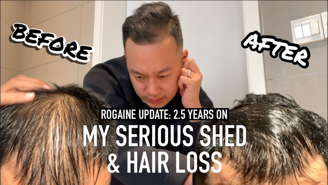 МОЙ ОБЗОР И ОБНОВЛЕНИЕ ROGAINE I САМАЯ СЕРЬЕЗНАЯ ЛИНЯЯ И ВЫПАДЕНИЕ ВОЛОС ПОСЛЕ 2,5 ЛЕТ ИСПОЛЬЗОВАНИЯ