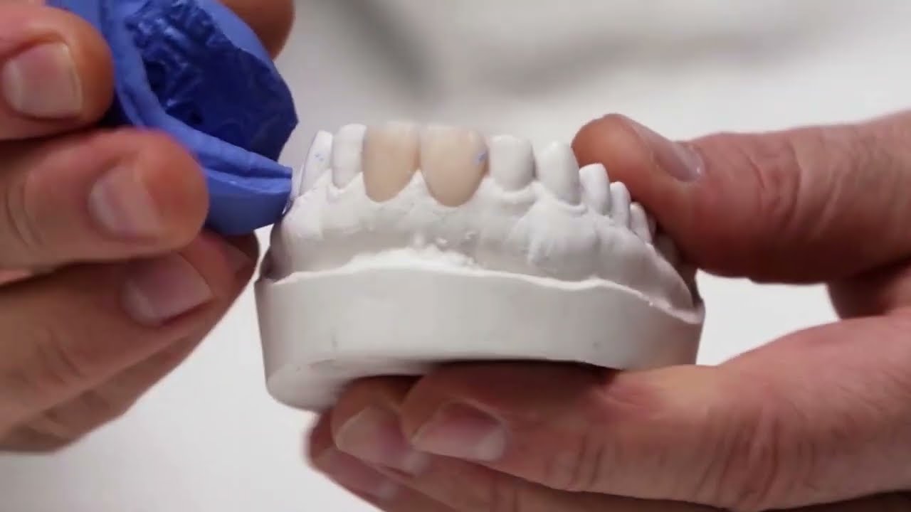 Dental Lab Procedure for Provisional Crown Restoration - TEASER VIDEO