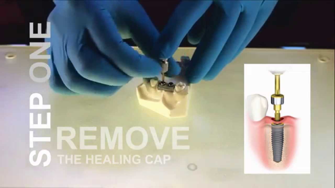 How to make impressions for dental implants