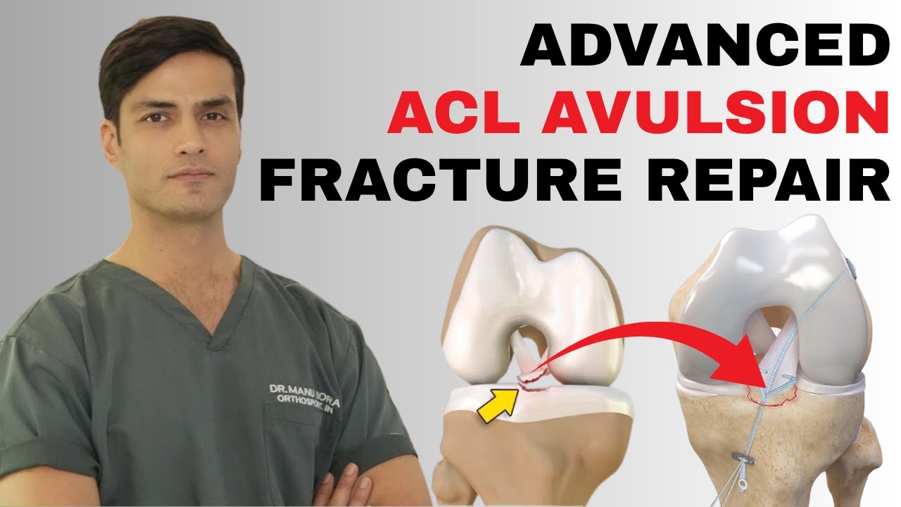 ACL Ligament बिना टूटे हड्डी के साथ उखड जाये, ACL Tibial Spine Avulsion Fracture Repair Fixation