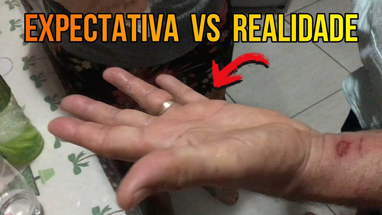 Como Tirar Um Anel do Dedo Inchado EXPECTATIVA vs REALIDADE - Tutorial  #shorts