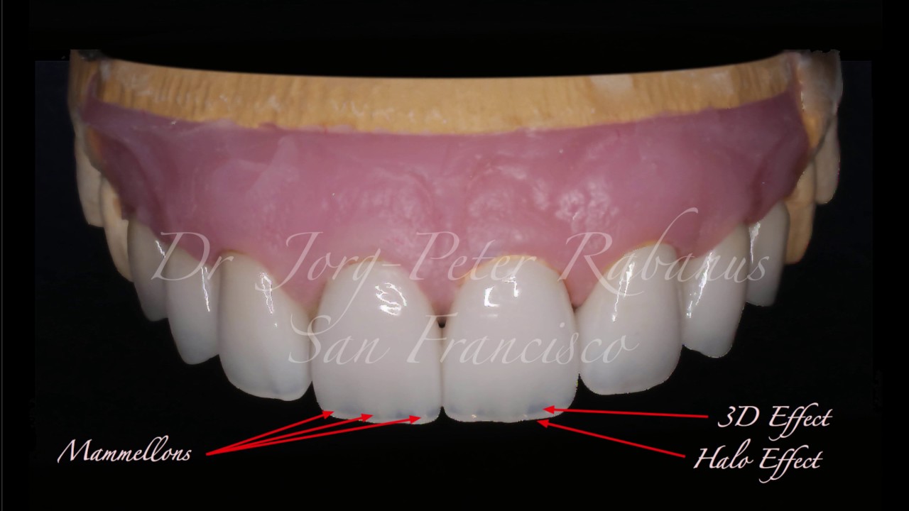 Porcelain Veneers - Three Micro Elements