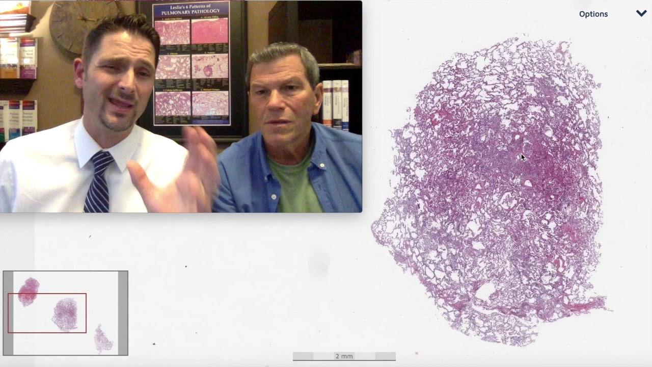 Pattern 1 - Acute Lung Injury, Vaping Associated Lung Injury (Top 25 Pearls Series, Topic 1 Pearl 2)