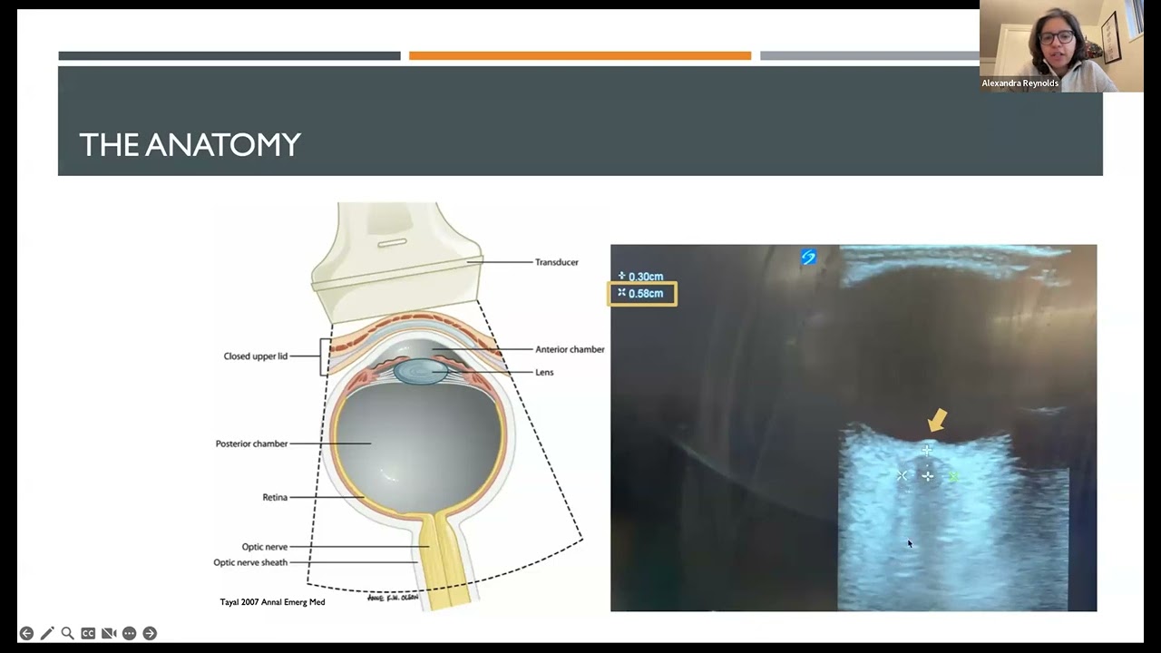 Neurocritical Care & Pearls: Noninvasive Monitoring of Intracranial Pressure, Alexandra Reynolds, MD