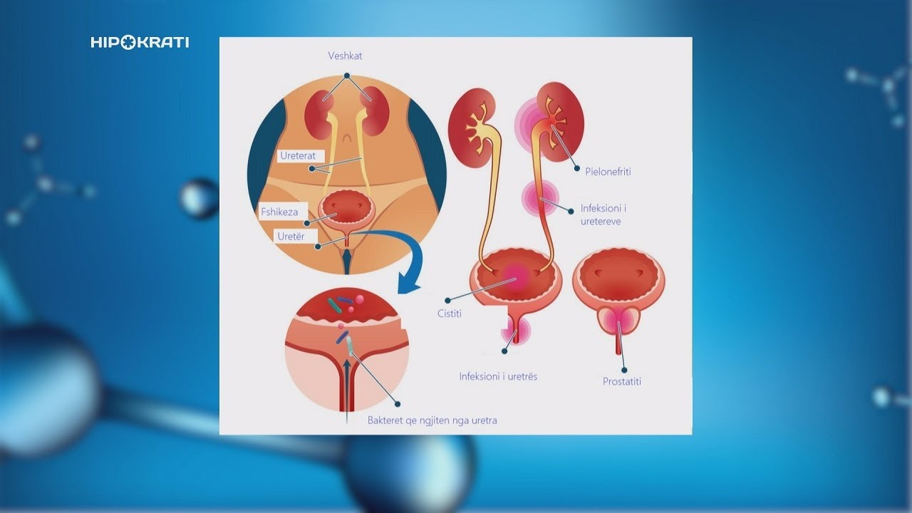 Hipokrati- Infeskionet urinare, pse gratë vuajnë më shpesh.Ja kur duhet të shqetësoheni!
