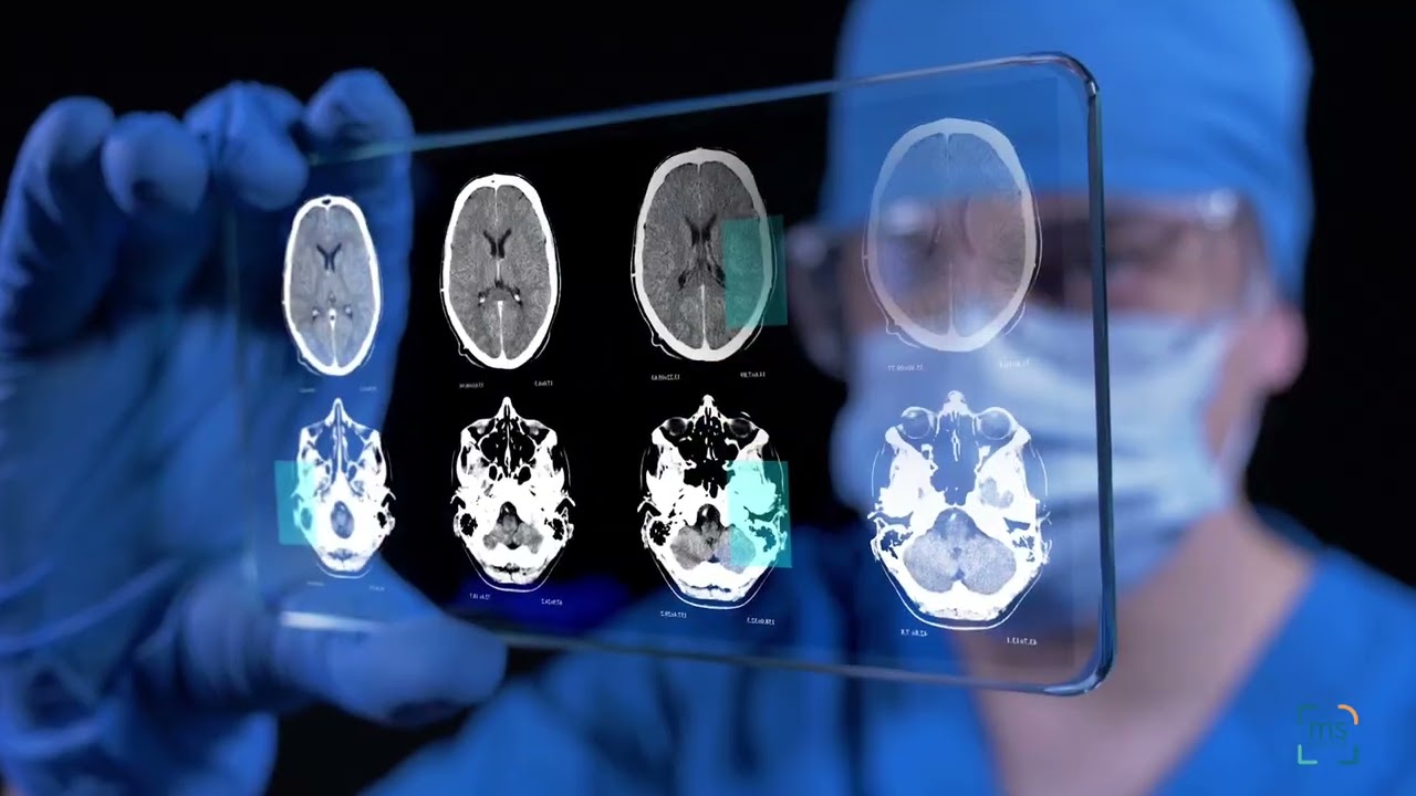 Serum Neurofilament Light Chain (sNfL) in MS with Ben Thrower, M.D.