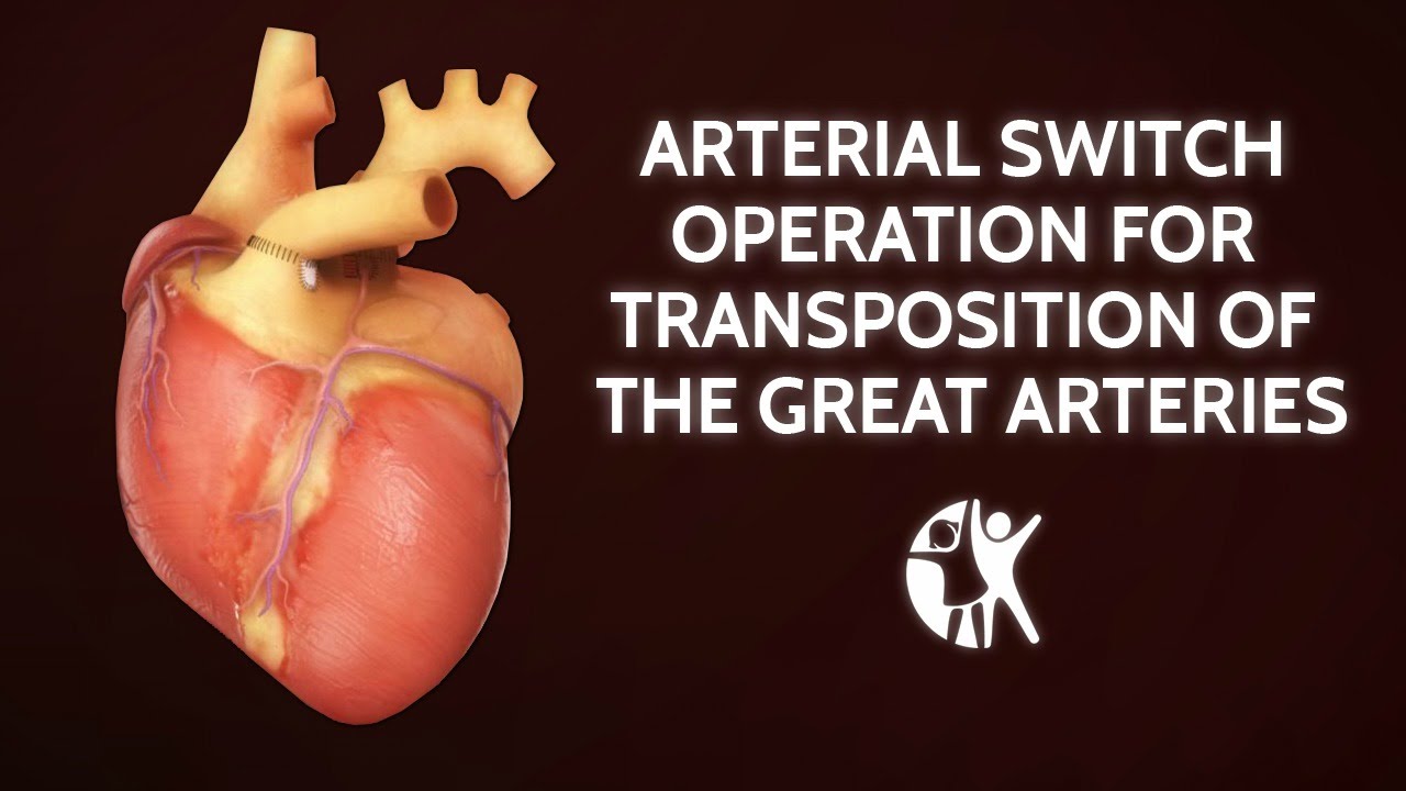 Arterial Switch Operation for Transposition of the Great Arteries | Cincinnati Children's