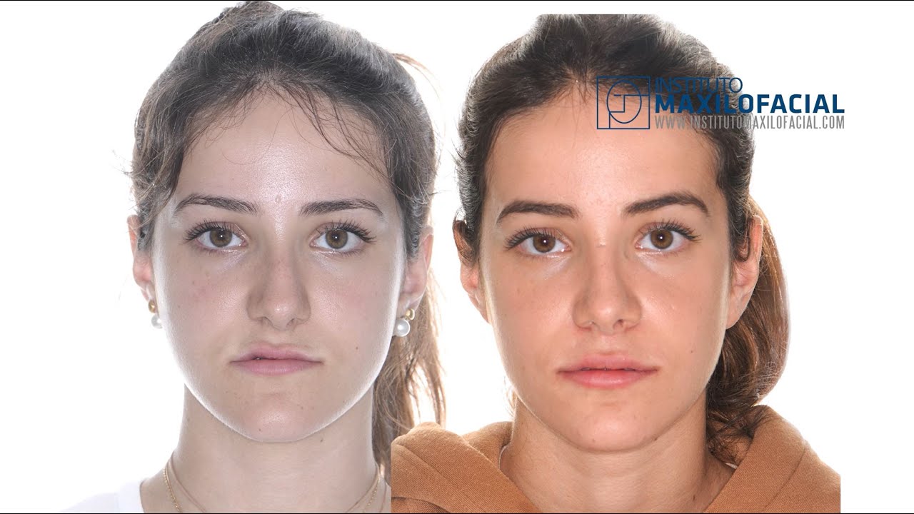 Orthognathic bimaxillary surgery. Case # 69: Alba- Class III bite, maxillary hipoplasia