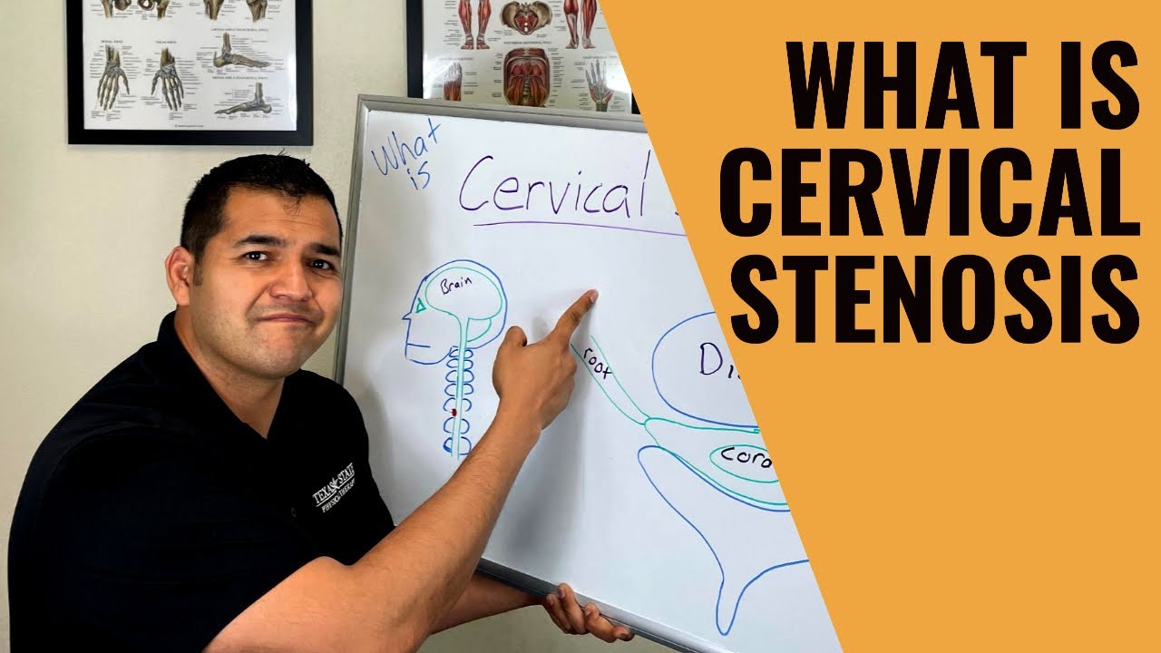 What Is Cervical Stenosis?