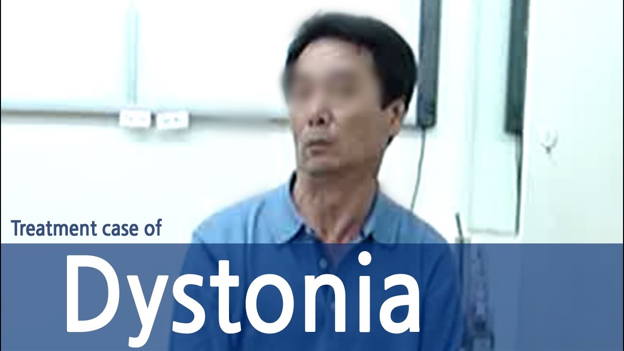 Dystonia / Cervical Dystonia / Spasmodic Torticollis /  사경증 치료사례 / 근긴장이상증