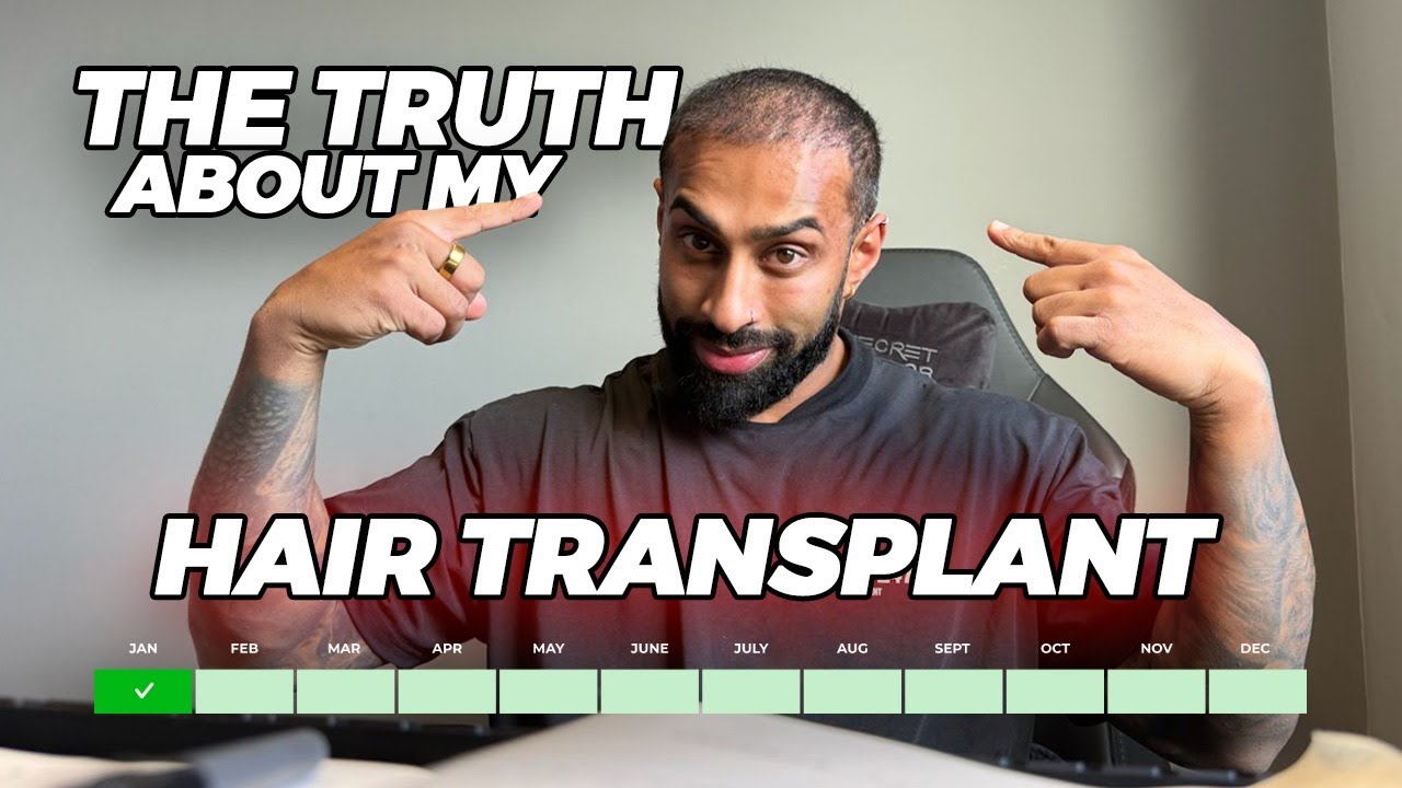 HAIR TRANSPLANT JOURNEY | WHY NOW? WHY I CHOSE COSMEDICA | 1 MONTH REVIEW