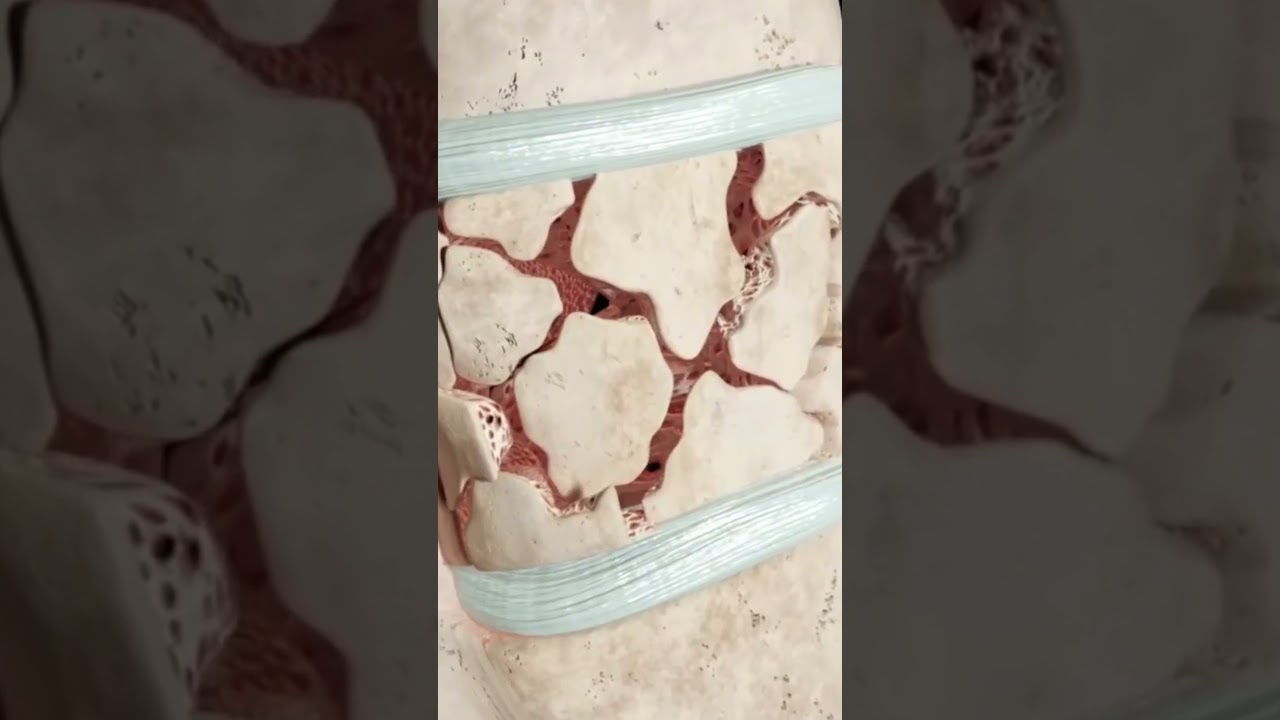 Pseudoartrosis