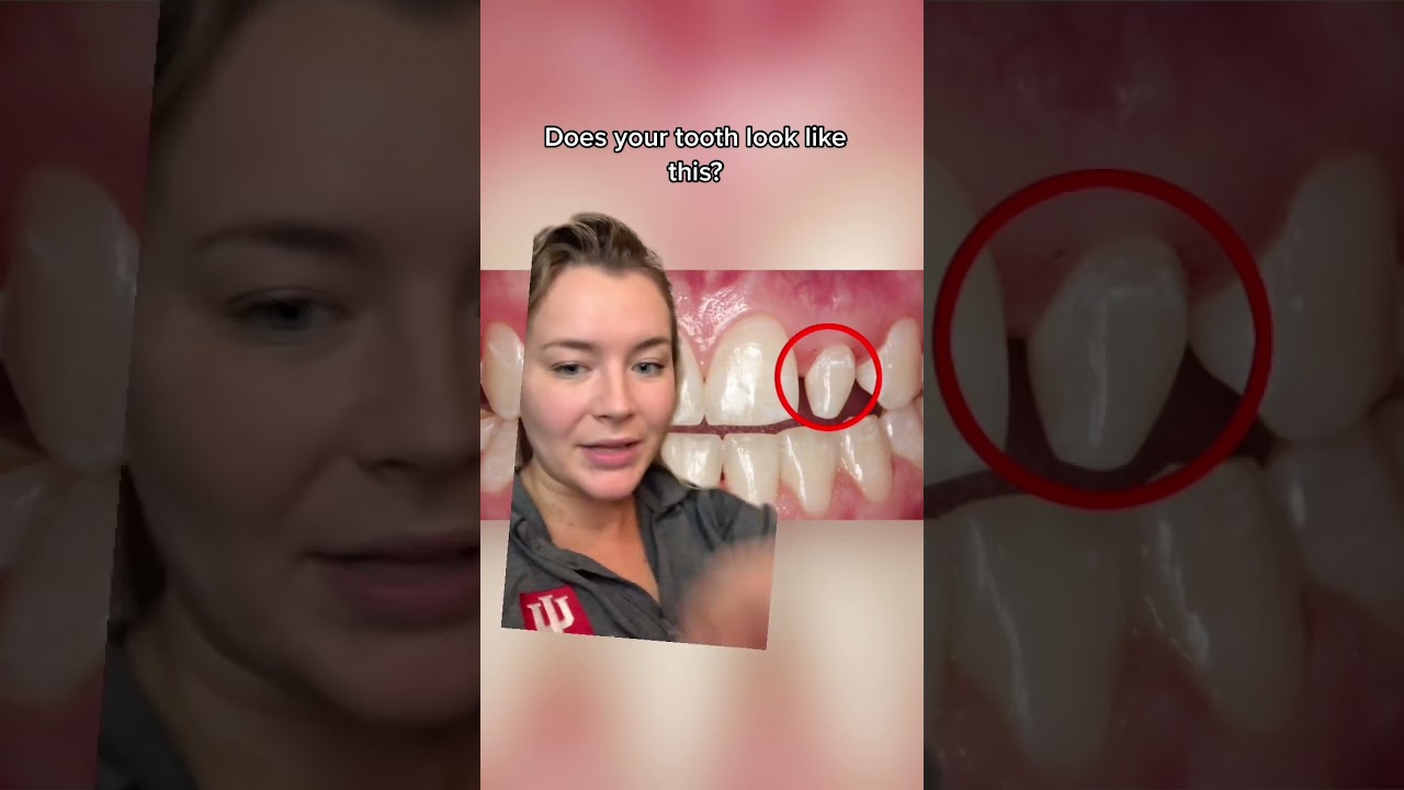 Peg laterals are pretty common! It&rsquo;s like the tooth that gets to express itself in your mouth 😂