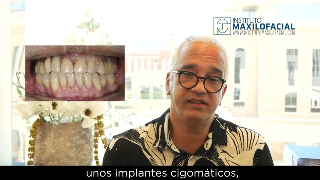 ROBERTO - Rehabilitación de la arcada superior con implantes cigomáticos