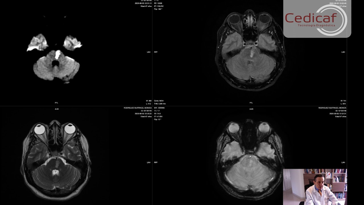 Caso Clínico Micro angiopatia Cerebral (Infartos Lacunares Multiples) Dr Jorge Ivan Ospina