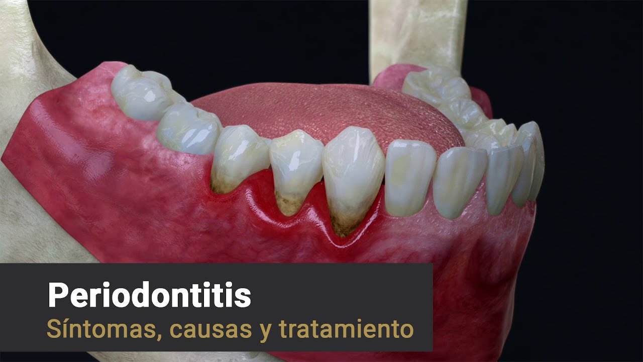 Provenza Clínica Dental - Periodontitis: Síntomas, Causas y Tratamiento