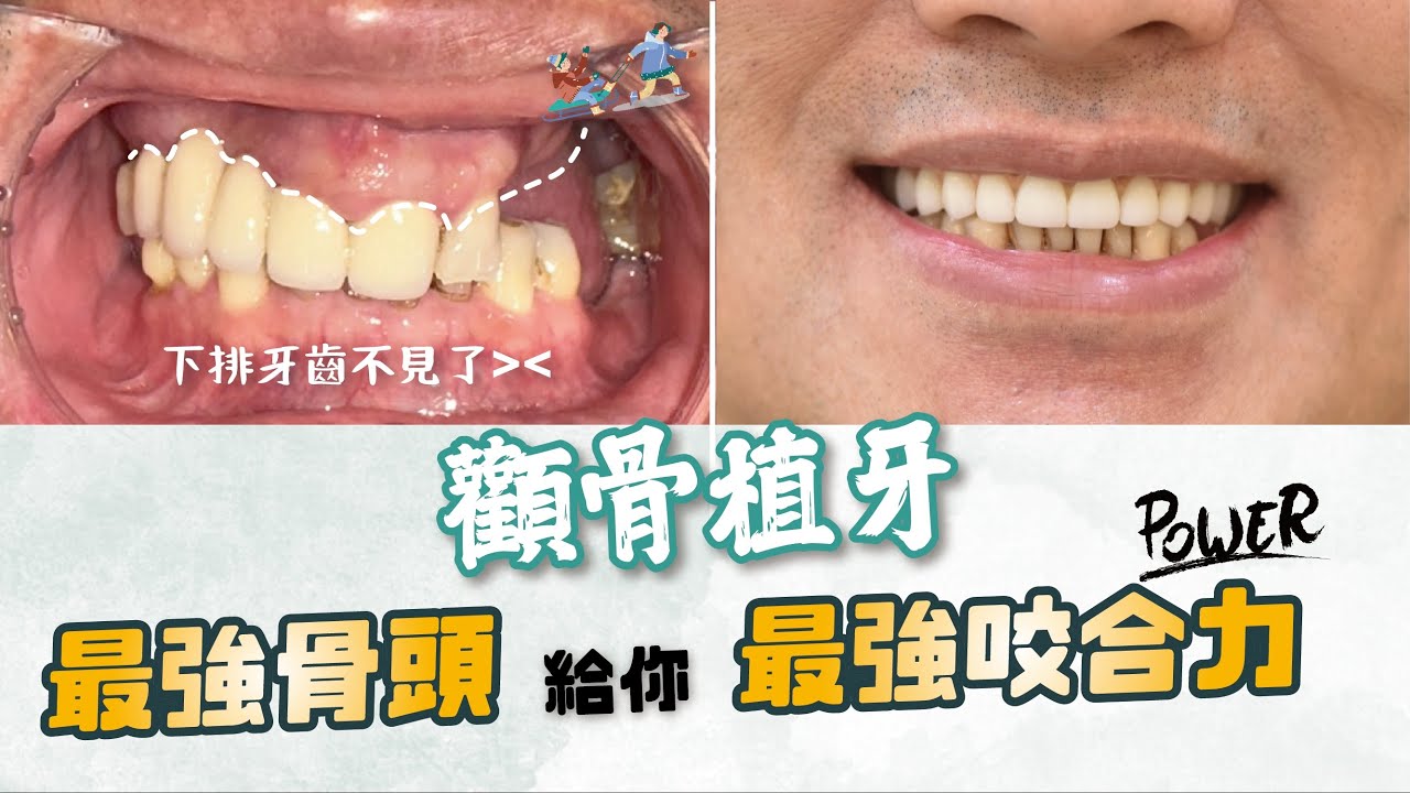 以為牙齒沒救？沒骨頭也能做，讓進階版全口重建來幫忙！