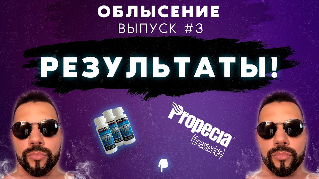 Облысение и Выпадение волос у мужчин . Результаты после 3-х месяцев !