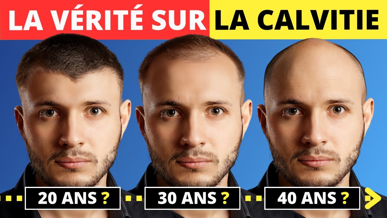 Pourquoi et comment vos cheveux tombent 😱 - La vérité sur la calvitie