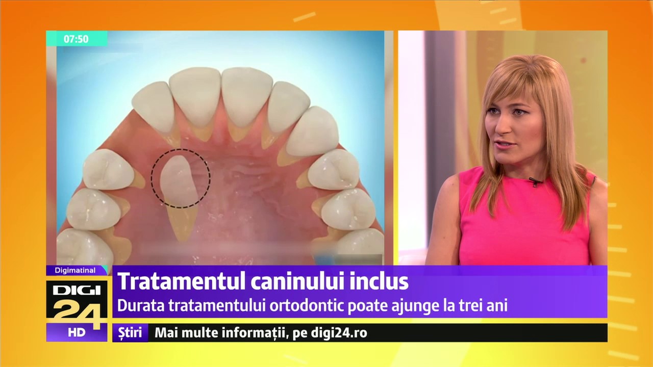 Tratamentul caninului inclus