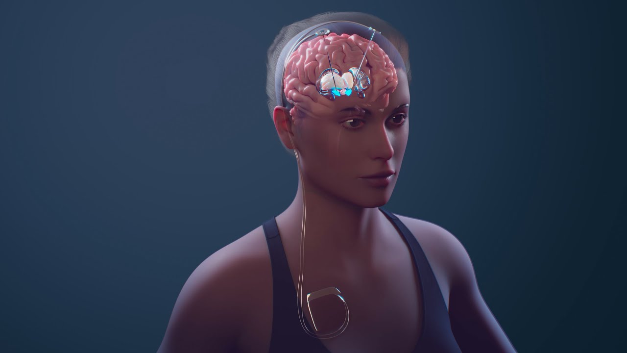 What is Deep Brain Stimulation Really Like?