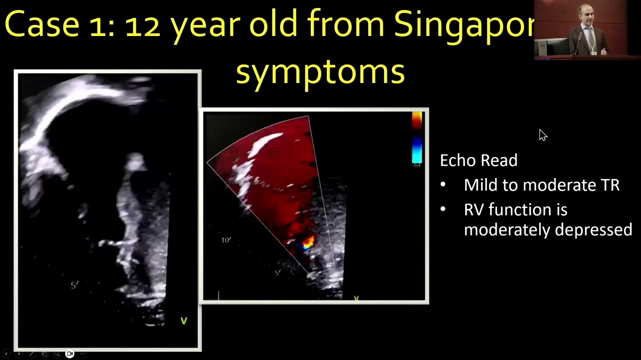 Cross-Sectional Imaging in Ebstein’s Anomaly - Tarek Alsaied, MD