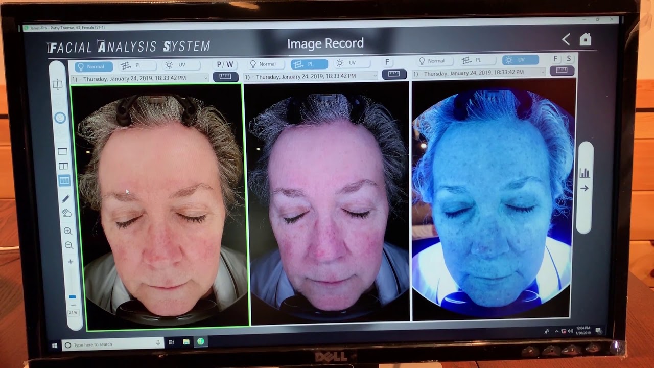 3D Skin Analysis with the Pear