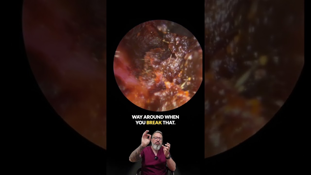 Too Deep for Tools? Watch This Ear Wax Removal Transformation!