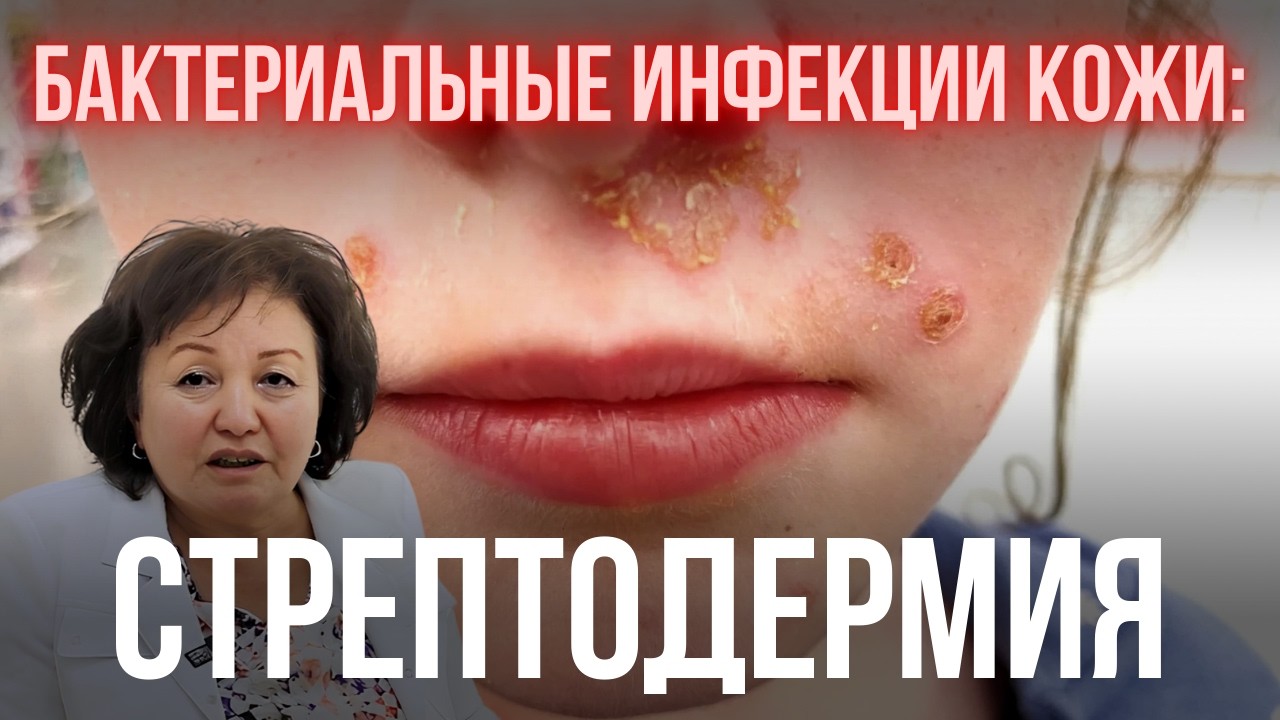 БАКТЕРИАЛЬНЫЕ ИНФЕКЦИИ КОЖИ: СТРЕПТОДЕРМИЯ
