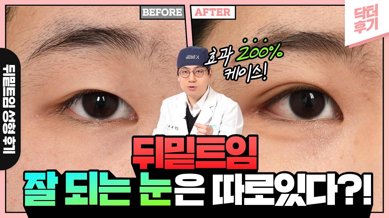 닥터후기] 뒤밑트임 효과 200% 보장! 잘 트여지는 눈은 따로 있습니다. 이런분은 꼭 트임 성형하세요. - 닥터 오승현