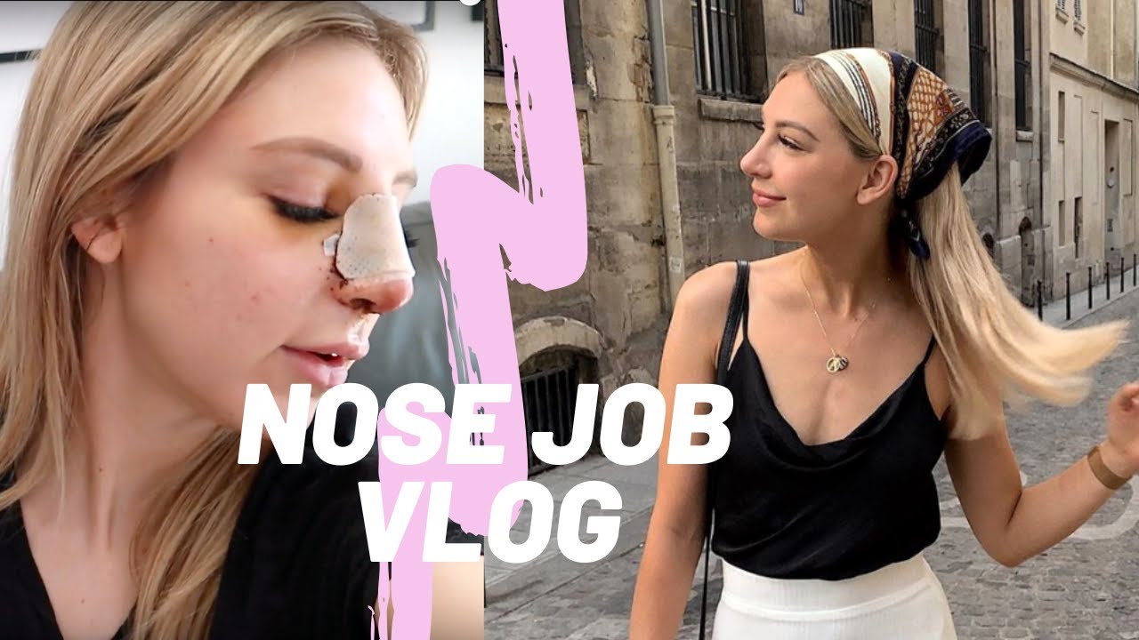 My Rhinoplasty Experience | From Surgery to Recovery