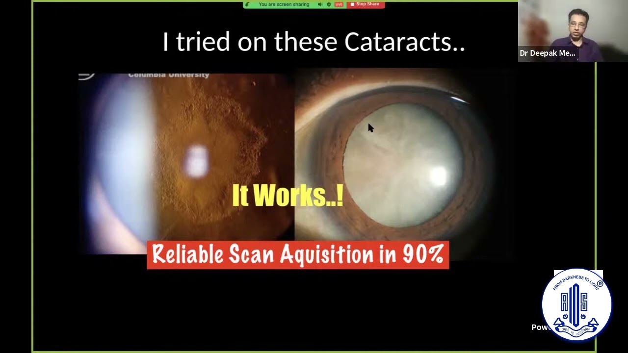 Our Clinical Experience with Swept Source Biometry IOLMASTER 700 - Dr Deepak Megur