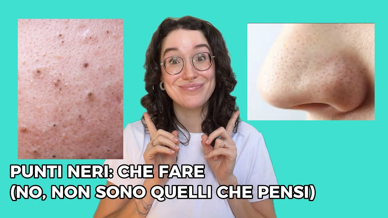 PUNTI NERI: COSA FARE (E NO, NON SONO QUELLI CHE PENSI TU)