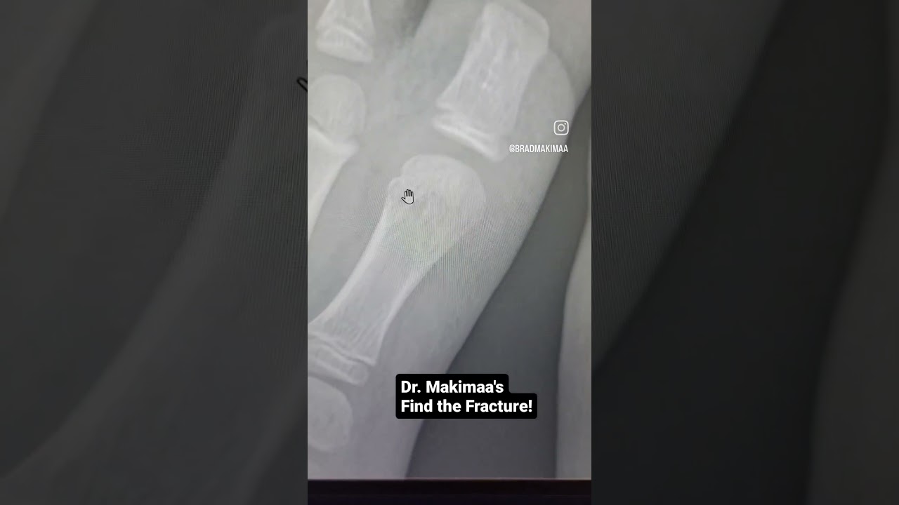 Find the fracture - pediatric first metatarsal fracture