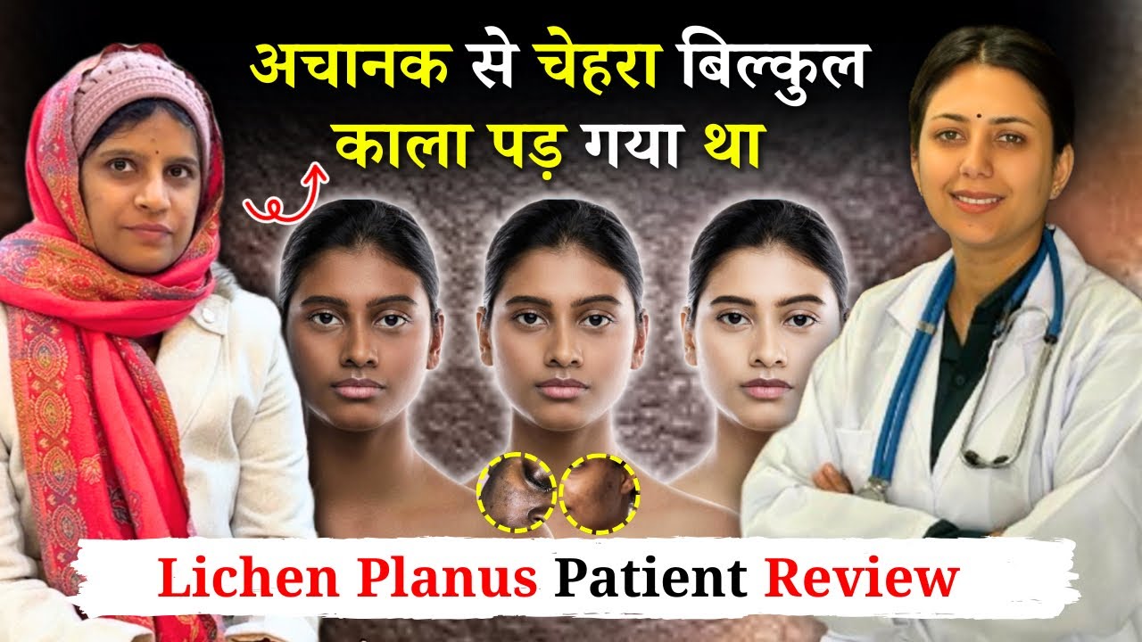6 साल से चेहरे के कालेपन से परेशान थी फिर ऐसे मिला छुटकारा | Lichen Planus का इलाज | Dr. Upasana