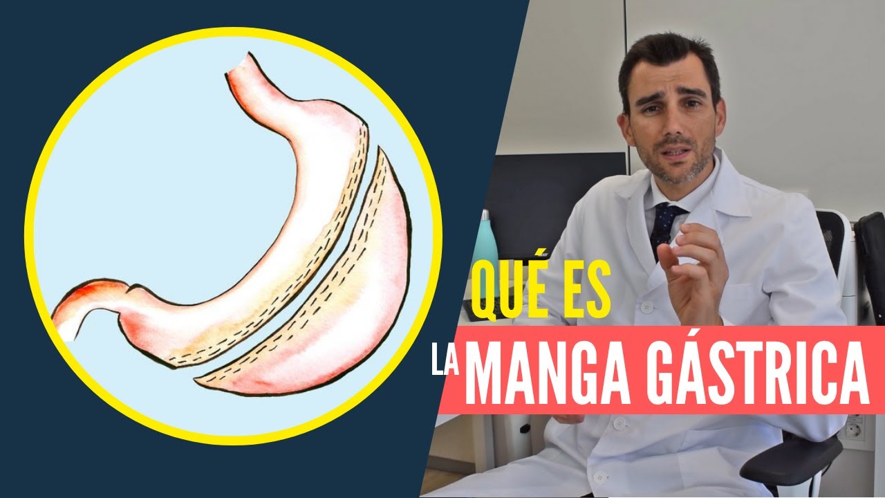 La Manga Gástrica: Qué es y cuándo utilizarla - Doctor Álvaro Bueno Delgado
