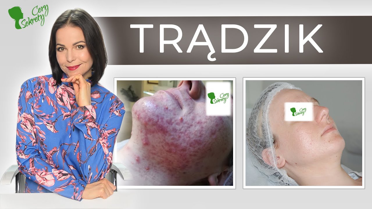 JAK WYLECZYĆ TRĄDZIK?!  | Skuteczna terapia BEZ NAWROTÓW