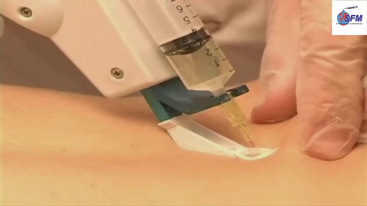 Mesotherapie Lumbago Lombalgie aigue Grand Public   Docteur Medecin Mesotherapeute   SFM
