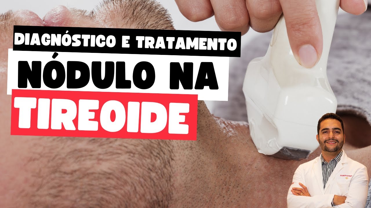 N&oacute;dulo na tireoide: como &eacute; o diagnostico e o tratamento