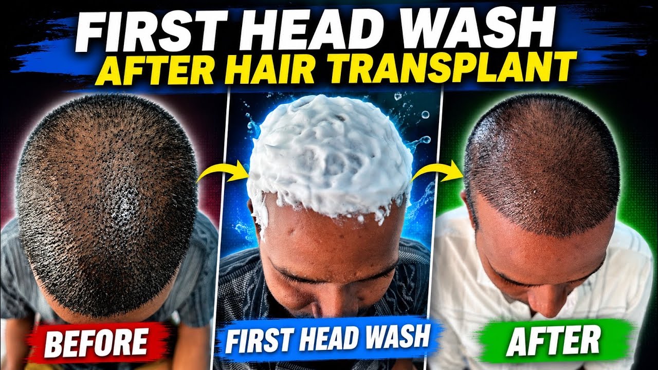 How to Wash Your Hair After Hair Transplant in Hindi? | Fue Hair Transplant Results 