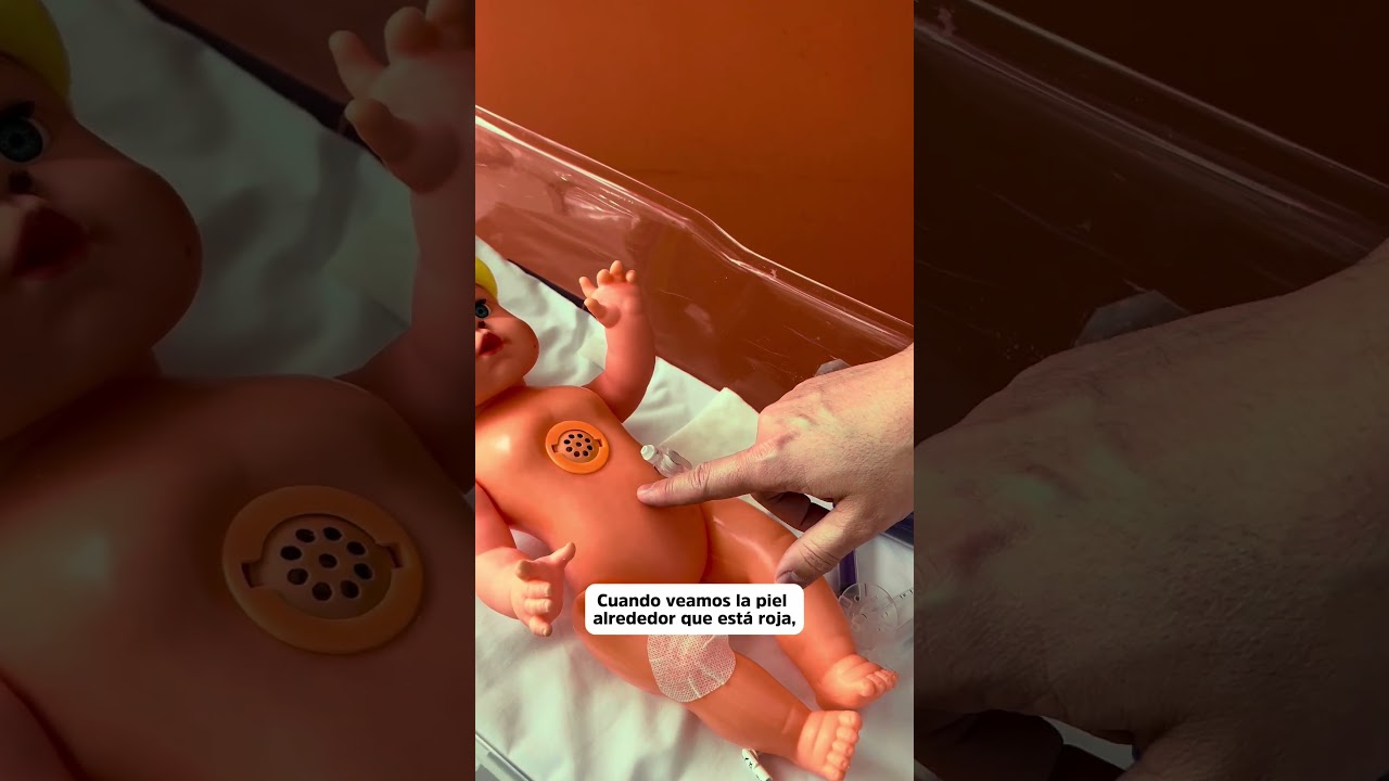 Cuidado y Manejo del Bot&oacute;n de Gastrostom&iacute;a en el Hogar