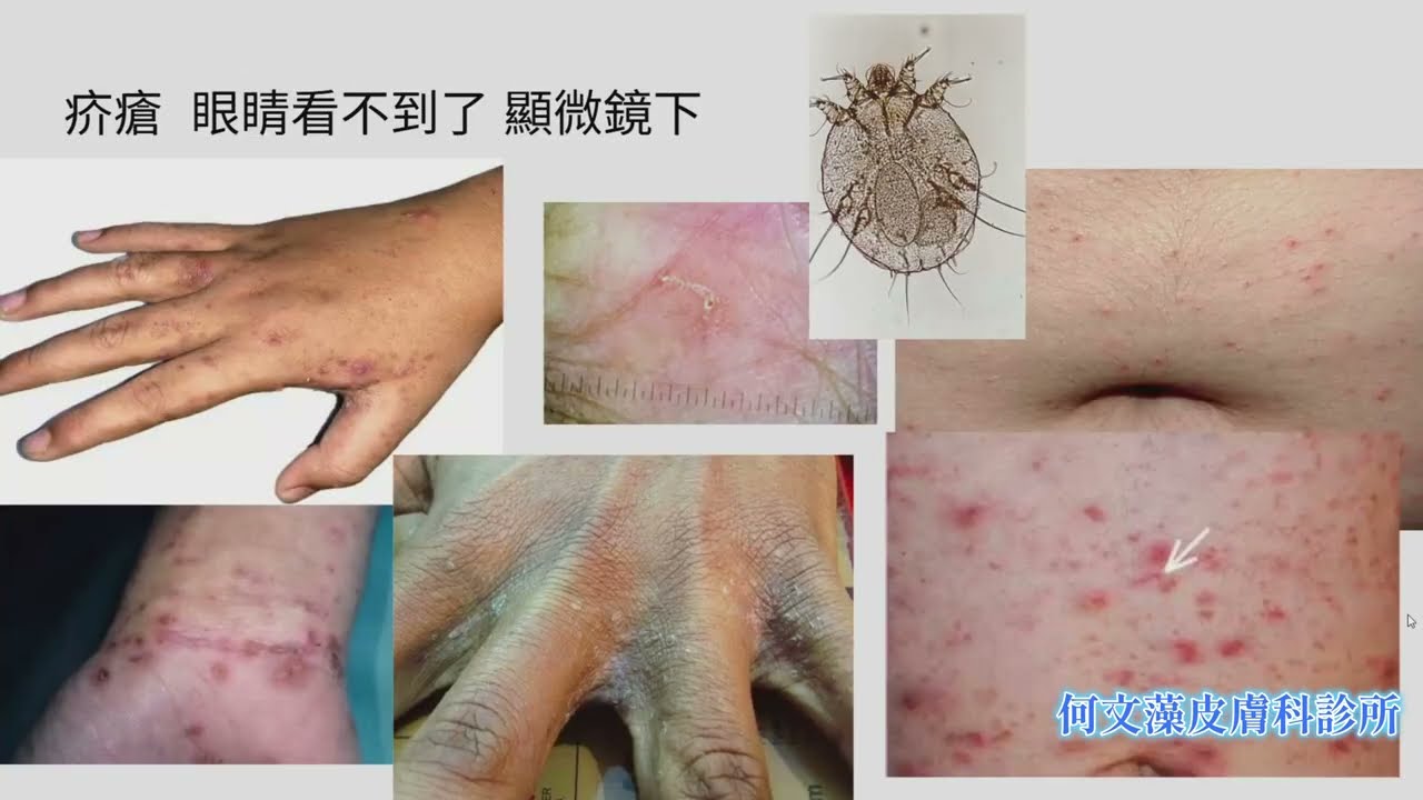 「皮膚癢不停？小心蟲蟲危機！蚊子，跳蚤，臭蟲，隱翅蟲，頭蝨、陰蝨、疥瘡與常見蟲咬大解析」 (何文藻皮膚科診所)