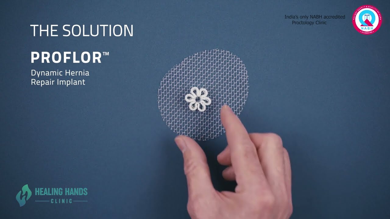 Сетка Proflor 3D | Хирургия паховой и пупочной грыжи | Доступно только в клинике Healing Hands в ...