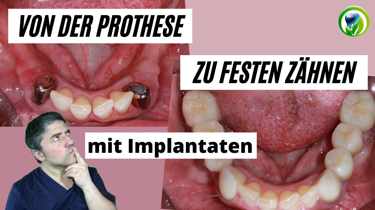 Von defekter Teleskopprothese zu festen Zähnen mit Implantaten, Kronen und Brücken - Patientenfall
