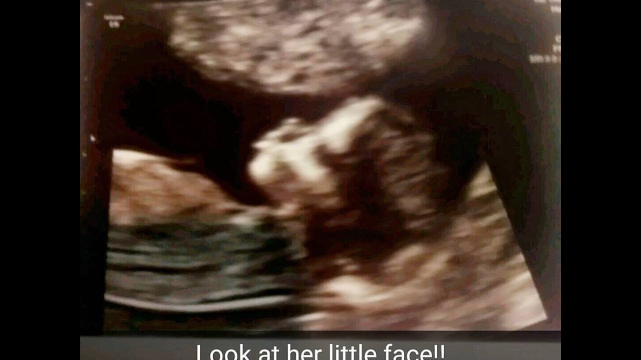 My PPROM Story, Waters Broke at 16weeks
