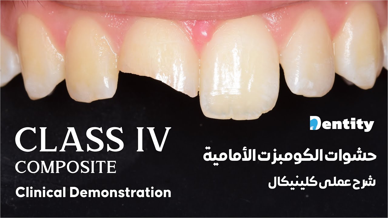 Class IV Composite | شرح عملي على حشوات الأسنان الأمامية