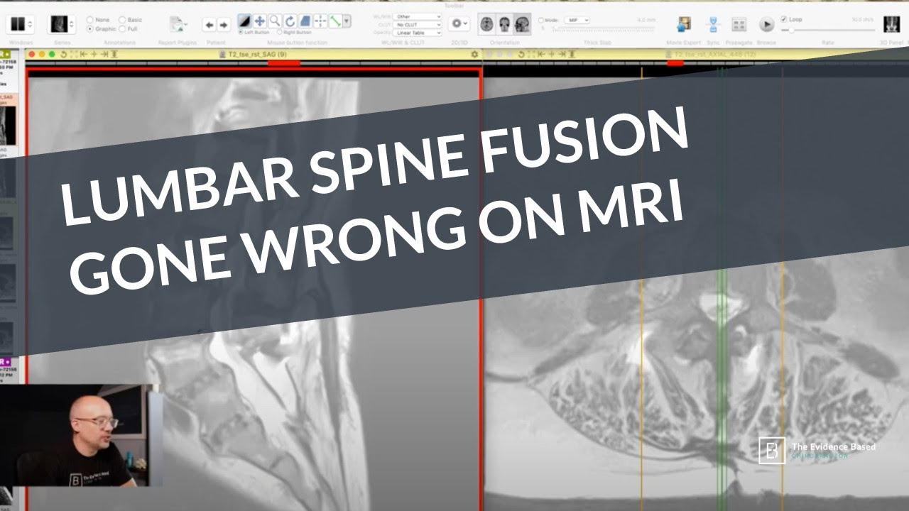 Lumbar Fusion Surgery Gone Wrong: A Live MRI Review
