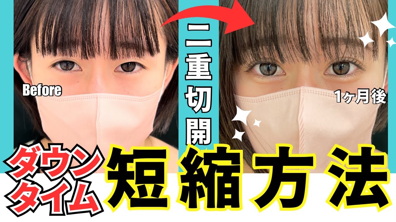 【ﾀﾞｳﾝﾀｲﾑ短縮方法❗️】二重切開法のダウンタイムを短くしたい方へ