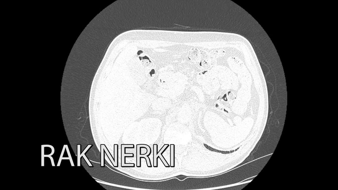 Rak nerki