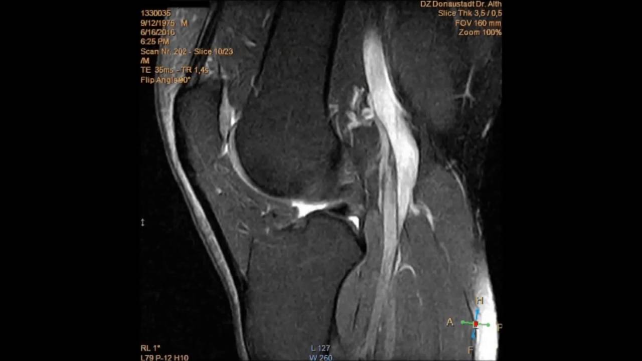 MRT (Magnetic Resonance Tomography) - left knee (MRI/IRM)